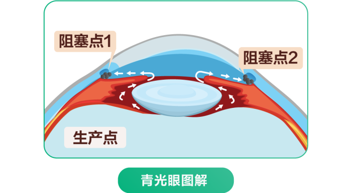 寒潮来临小心几个眼部症状