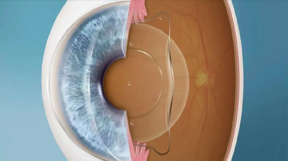 600度是近视分水岭~！千万别发展成高度近视！